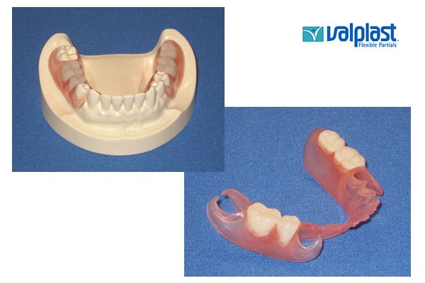 Valplast